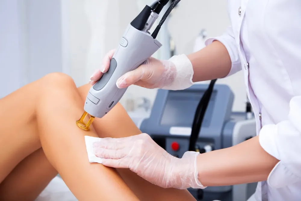 Épilation laser