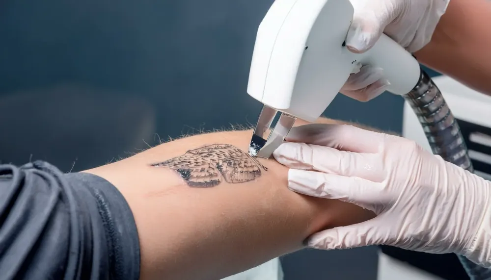 Laser détatouage