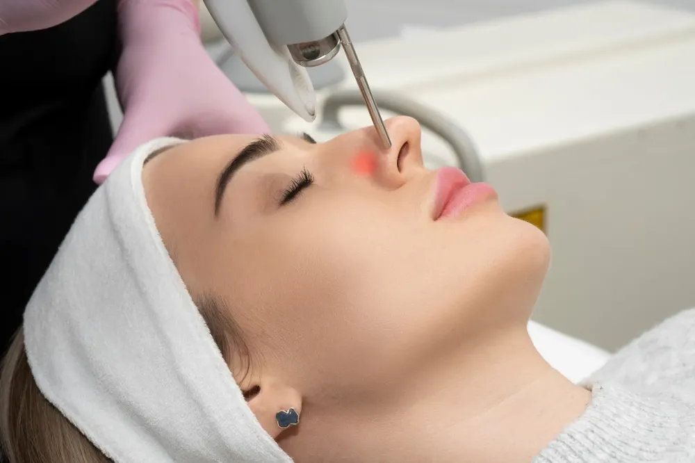 Effacer mes vaisseaux disgracieux et couperose au laser vasculaire